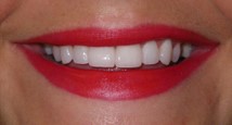 Teethdentalimplants after | porcelain veneers