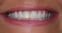 Teethdentalimplants before | porcelain veneers